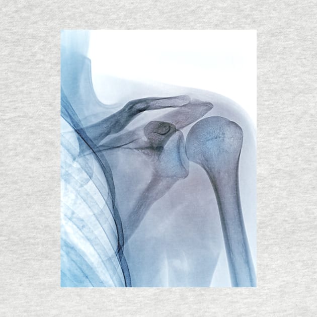 Shoulder joint, X-ray (C040/3239) by SciencePhoto